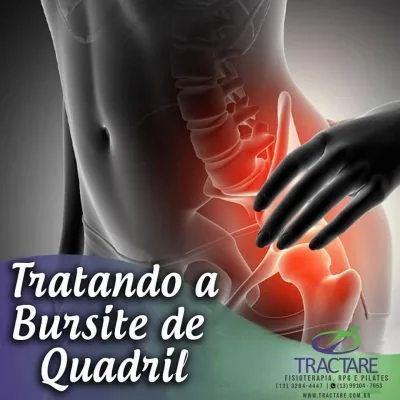 Bursite de Quadril - estudo de caso Tractare Santos